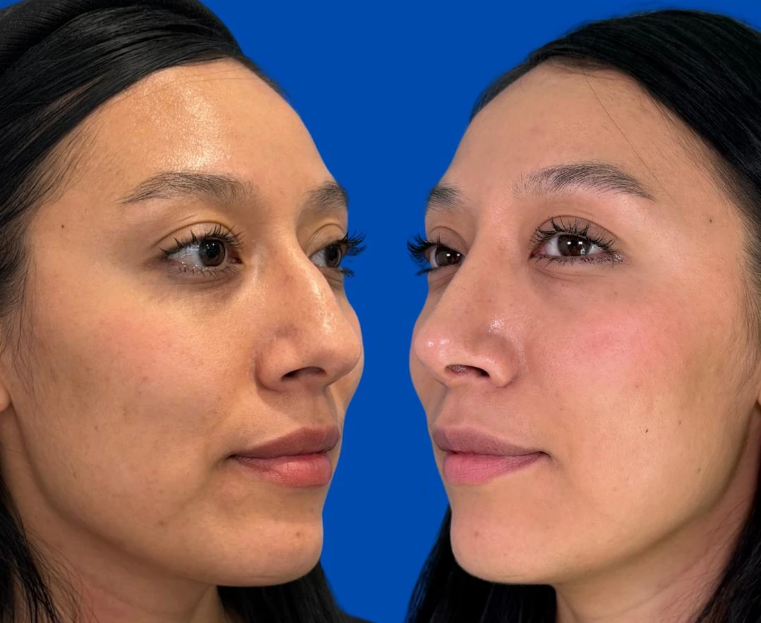 Resultado real de rinoplastia, comparativo en vista oblicua