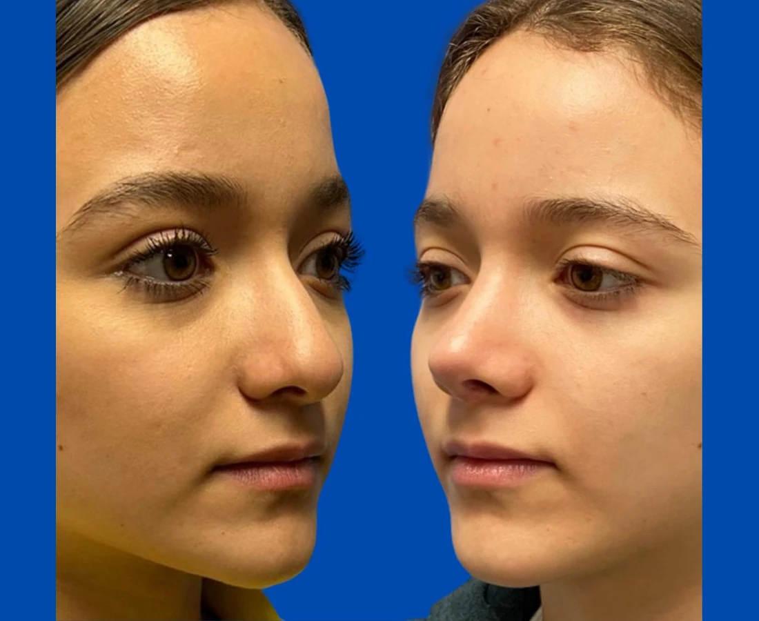 Resultado real de rinoplastia, segundo comparativo en vista oblicua